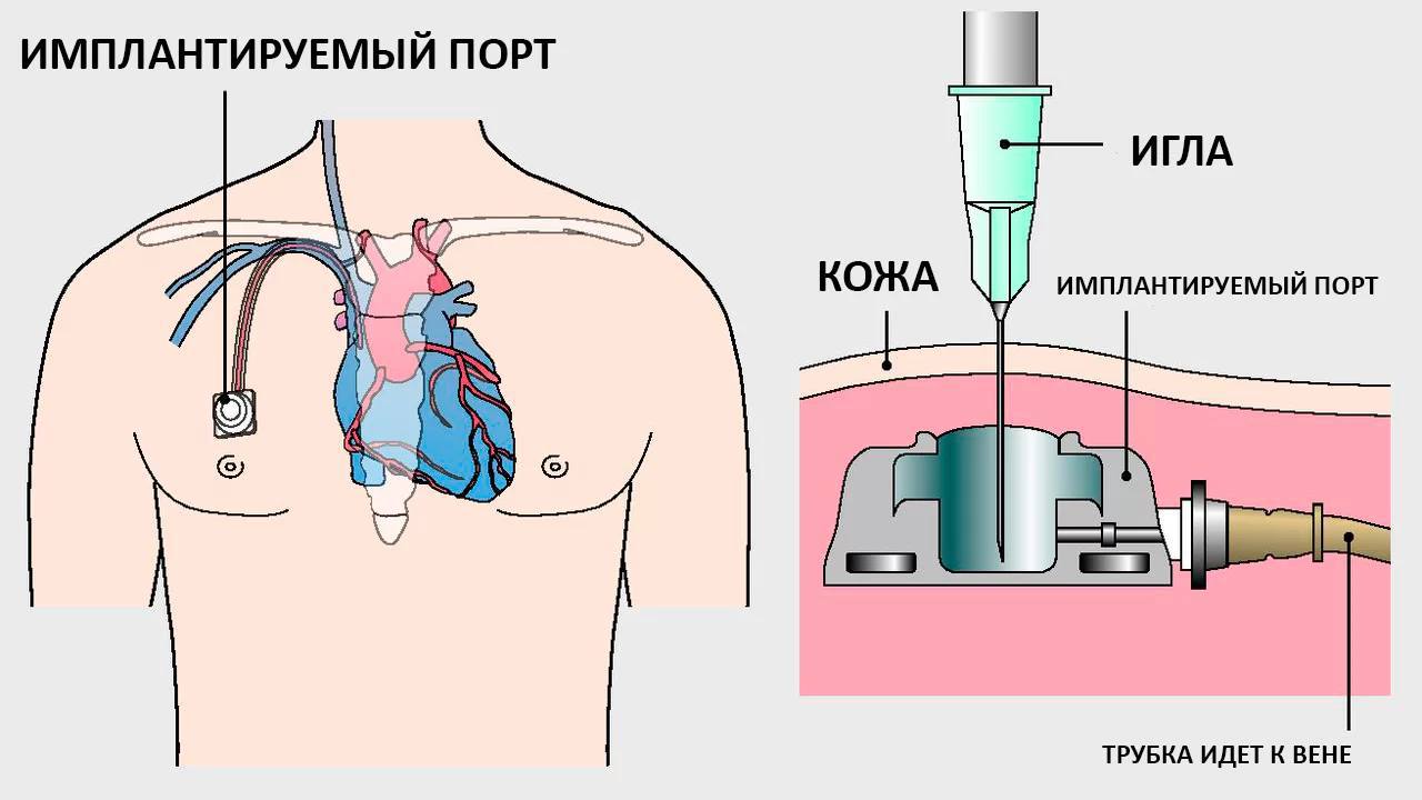 Центральный венозный катетер порт, порт-система. Порт-система для химиотерапии катетер. Порт система для внутривенного введения. Имплантированная венозная порт система.